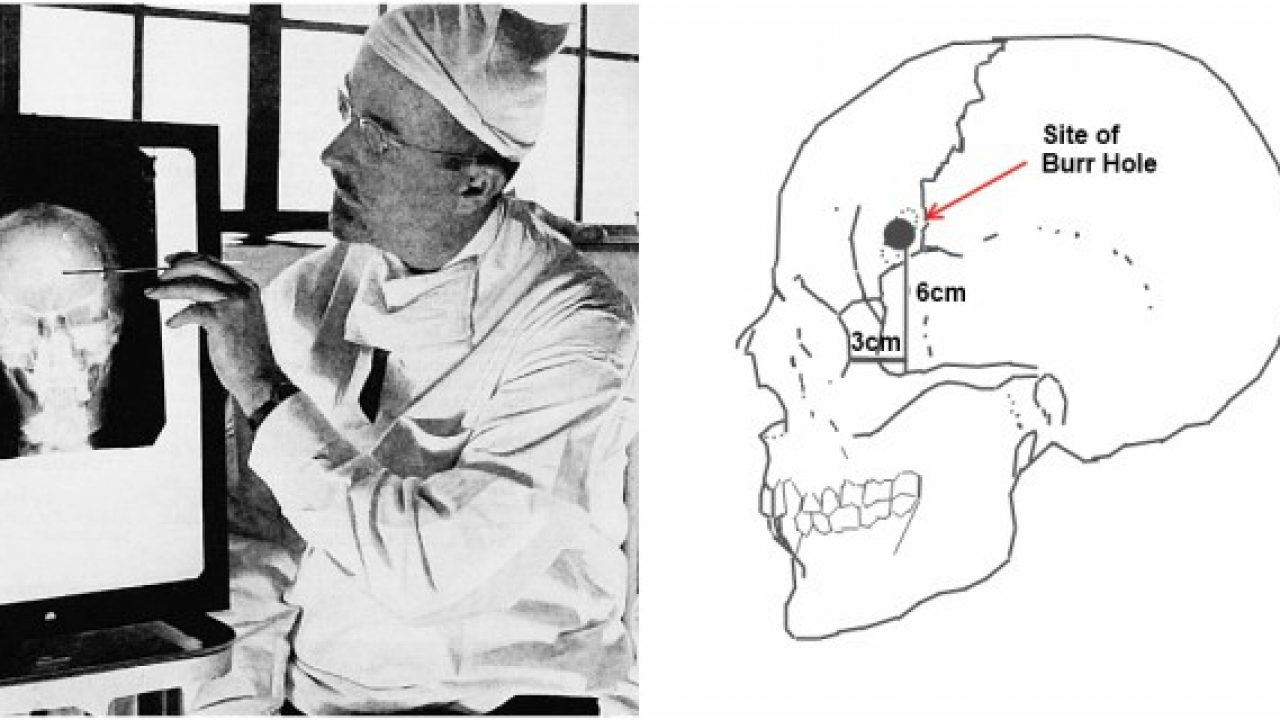 Walter Freeman Who Championed Lobotomy In The Us Was Touring With His Lobotomobile Demonstrating The Procedure